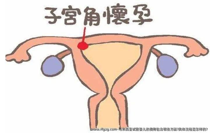 马来西亚代孕的费用包含哪些方面?具体流程是怎样的?