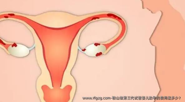 鞍山做第三代代孕助孕的费用是多少?